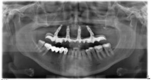 implantologia all on four all-on-4